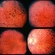Retinitis Pigmentosa